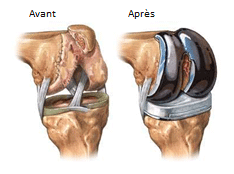 Prothèse du genou : avant - après